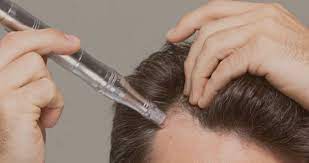 Microneedling for Hair Loss